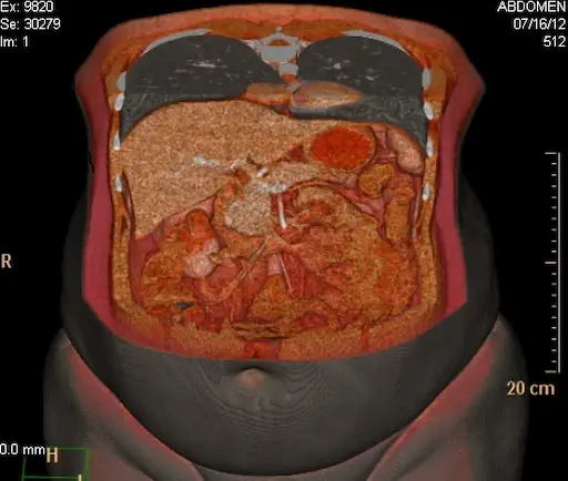 ¿Cuál es campo de Acción del Cirujano General? 4 Campo de trabajo abdominal del cirujano general